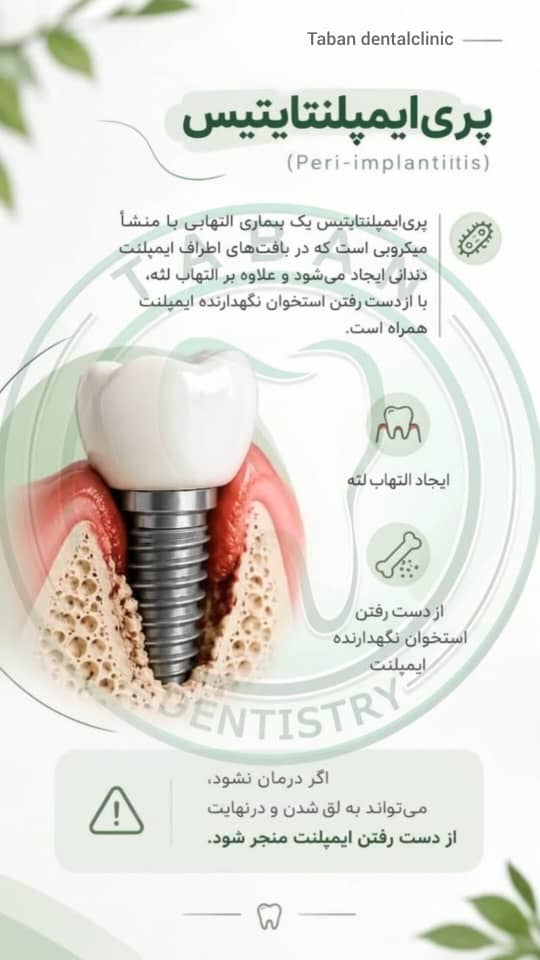 تصویر ایمپلنت مبتلا به پری‌ایمپلنتایتیس